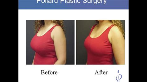 boob job gif|Breast Augmentation: Before and After Photos That Wow.